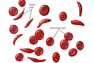 Sickle Cell Anaemia