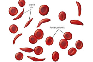 সিকল সেল রক্তাল্পতা